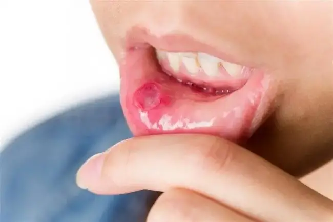 口腔潰瘍反復發作，如何好的快？還要警惕什麼？