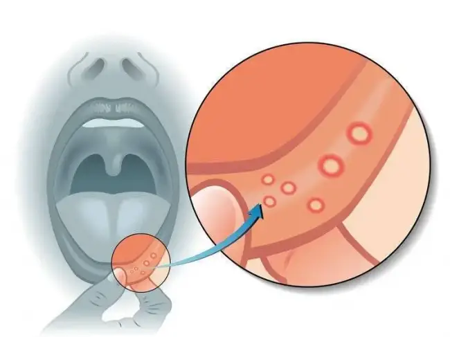 口腔潰瘍反復發作，如何好的快？還要警惕什麼？